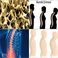 Kemik Erimesi (Osteoporoz) Nedir, Belirtileri Nelerdir, Kemik Erimesi Nasıl Önlenir?